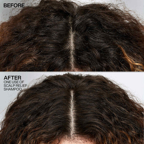 Resultados antes y después del tratamiento con shampoo Redken Scalp Relief Dandruff Control con piritiona de zinc, primer plano del cuero cabelludo